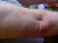 Bedbug rash